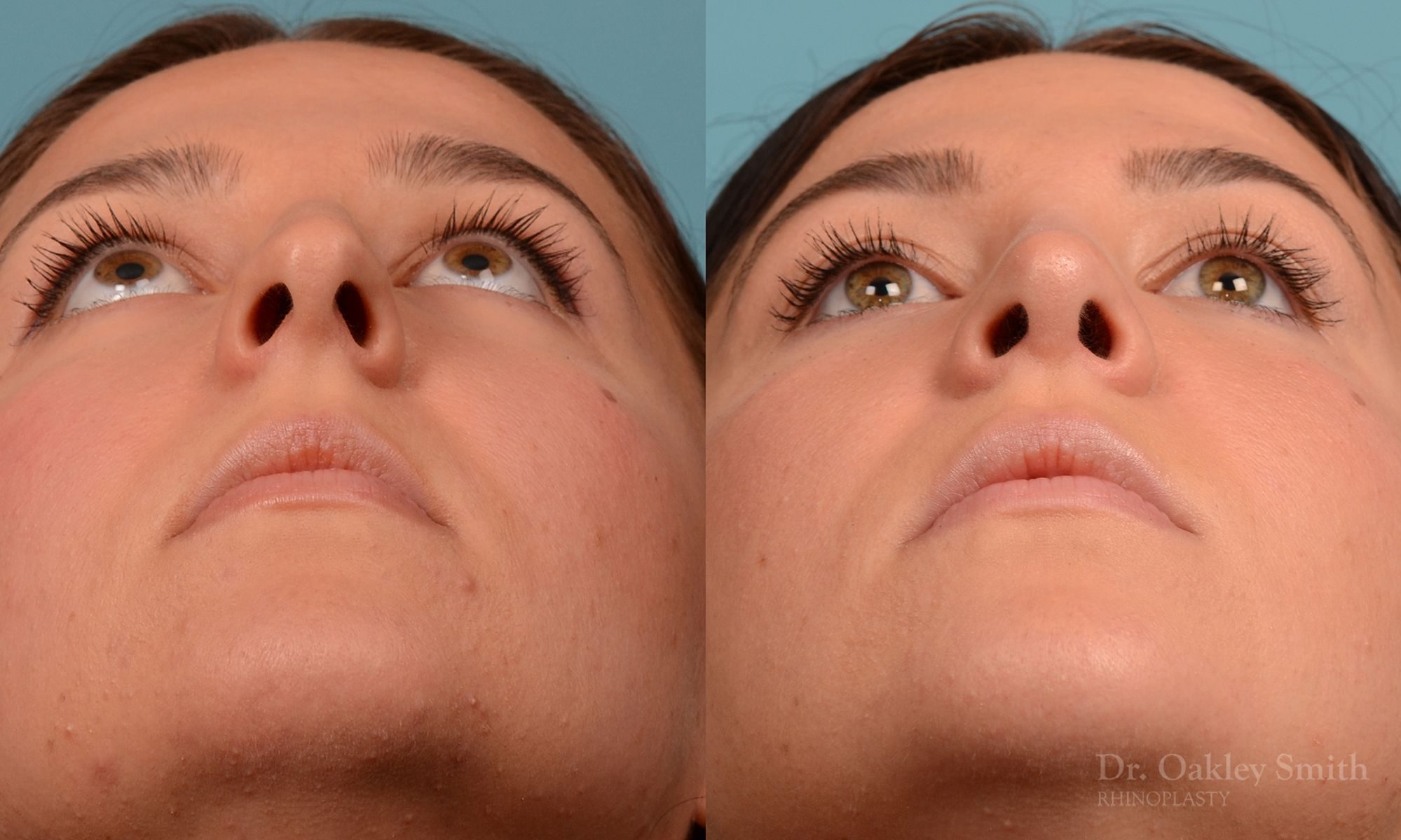 Rhinoplasty hump reduction