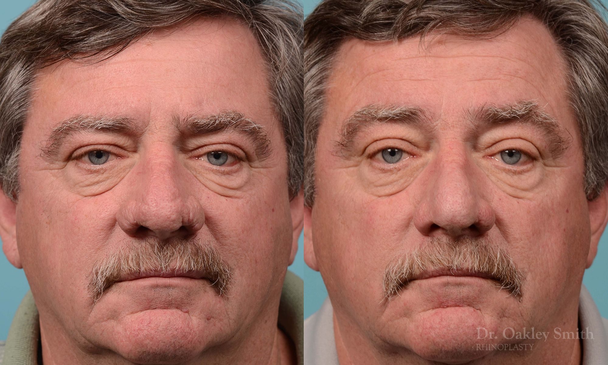 rhinoplasty elderly man