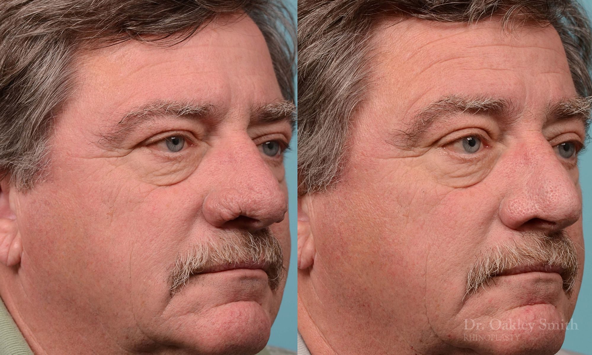 rhinoplasty rhinophyma elderly man