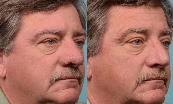 rhinoplasty rhinophyma elderly man