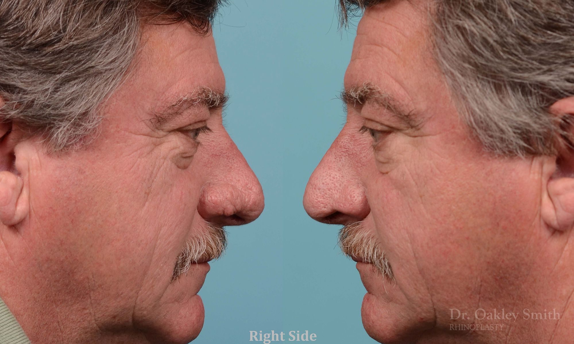 rhinoplasty elderly man