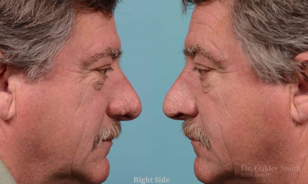 rhinoplasty elderly man