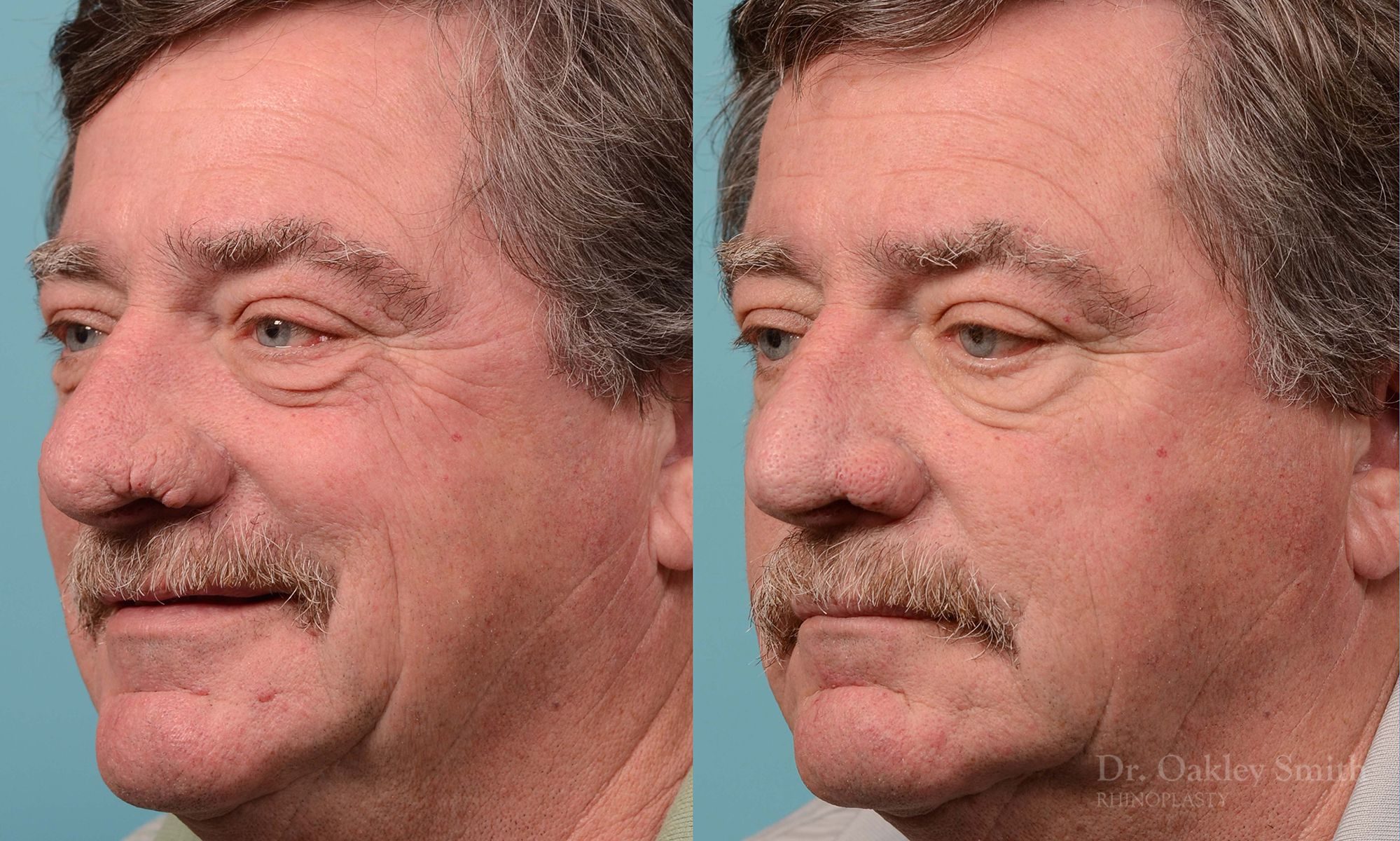 rhinoplasty elderly man