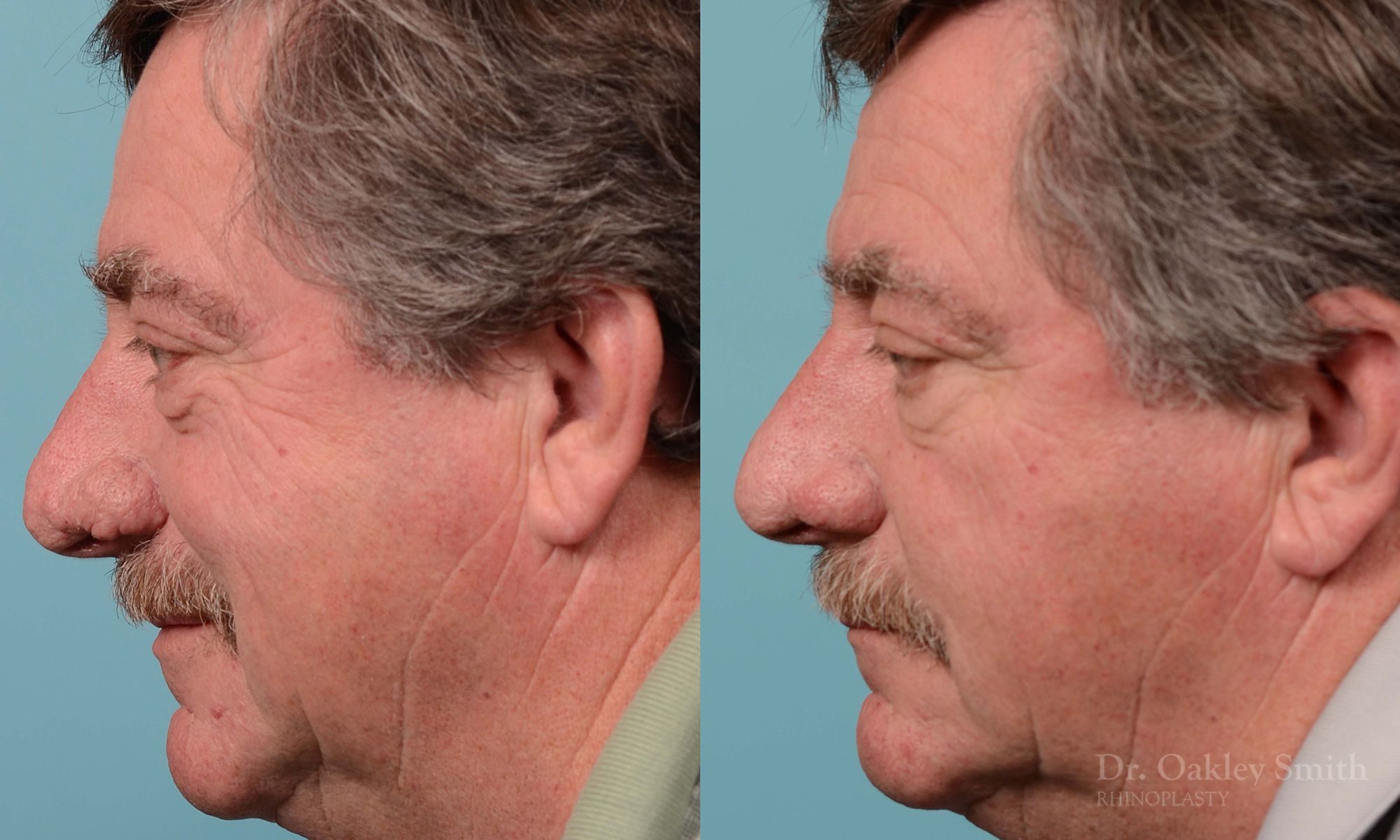 rhinoplasty elderly man