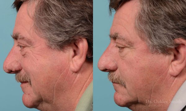 rhinoplasty elderly man