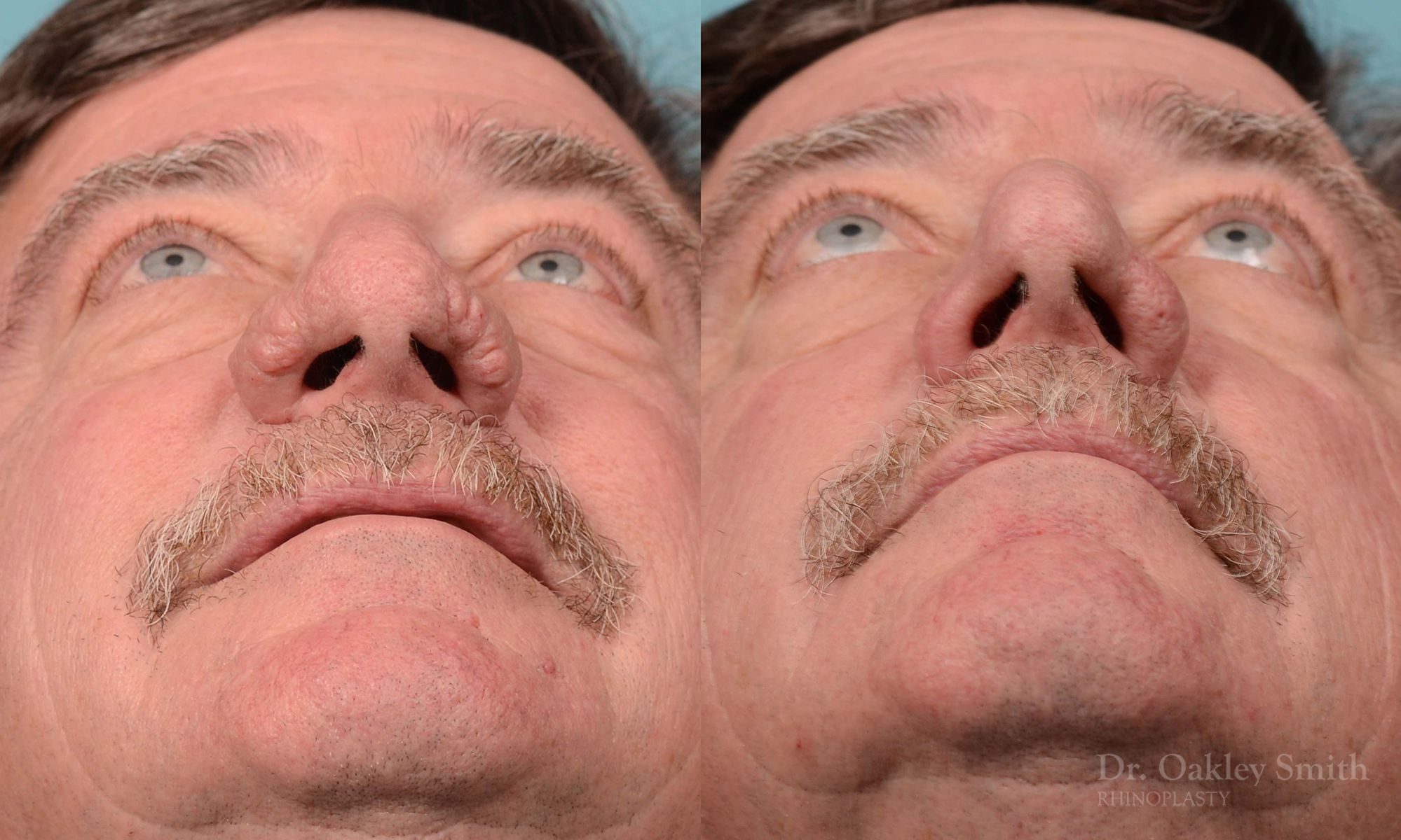rhinoplasty elderly man