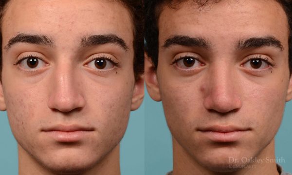 Broken nose rhinoplasty