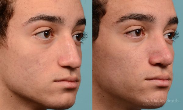Broken nose rhinoplasty