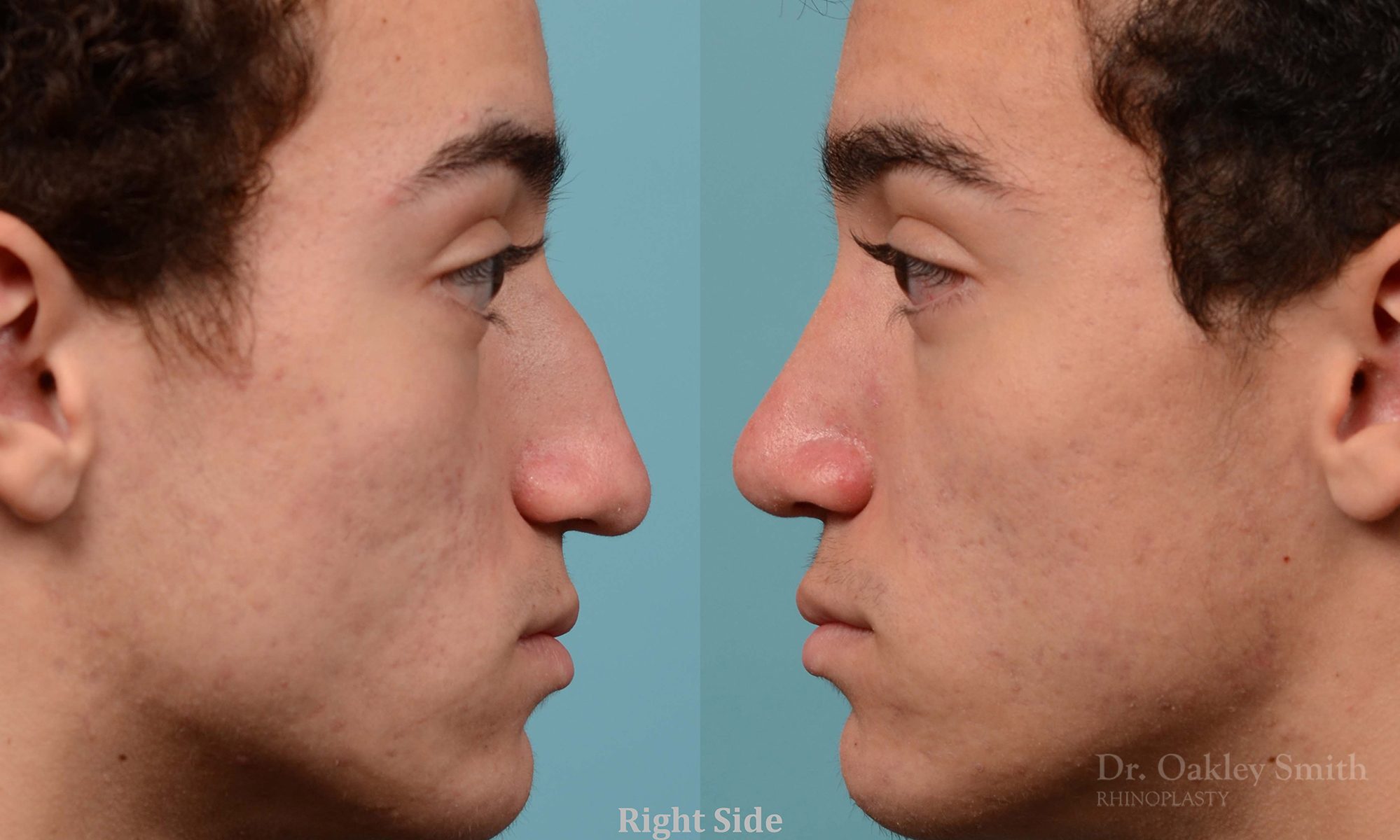 Broken nose rhinoplasty