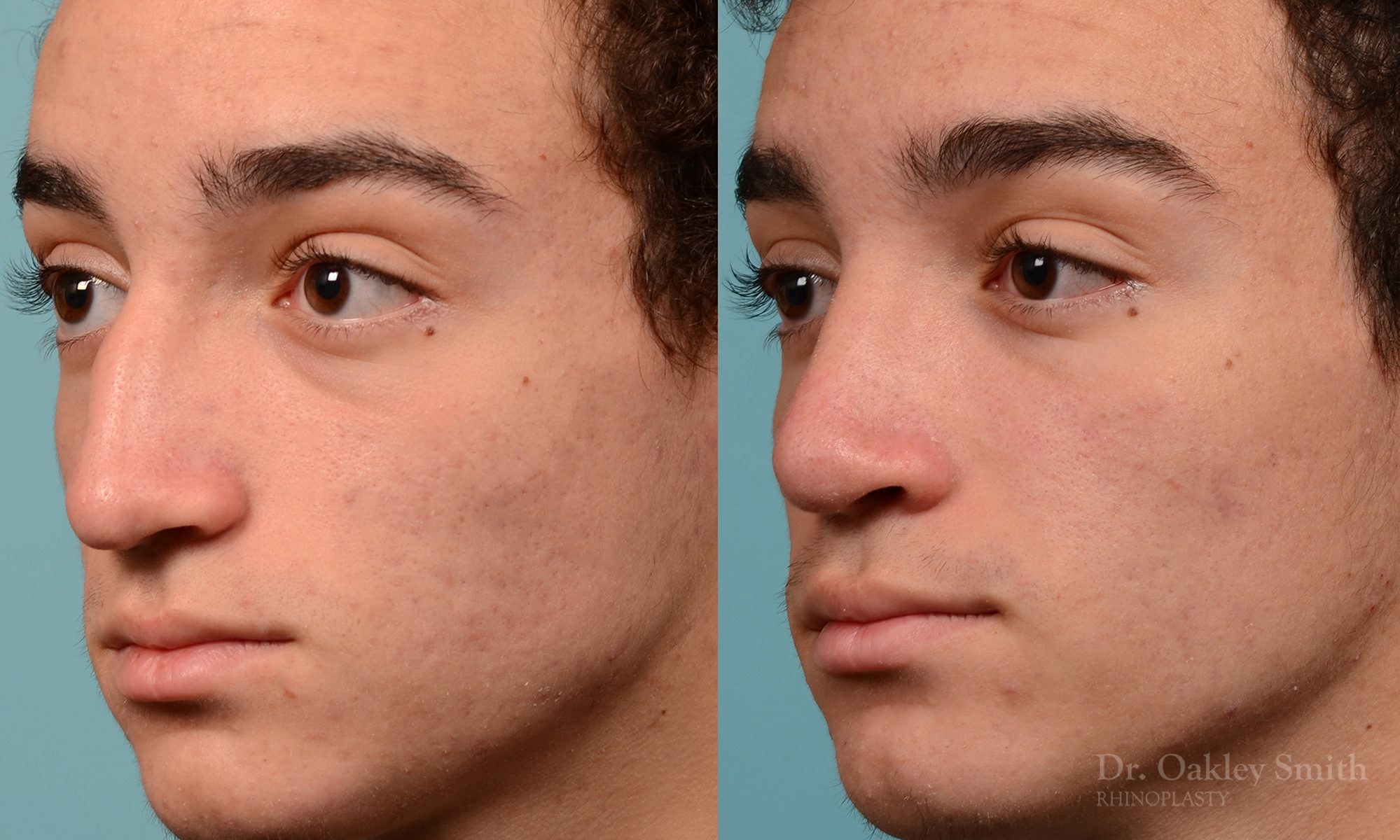 Broken nose rhinoplasty