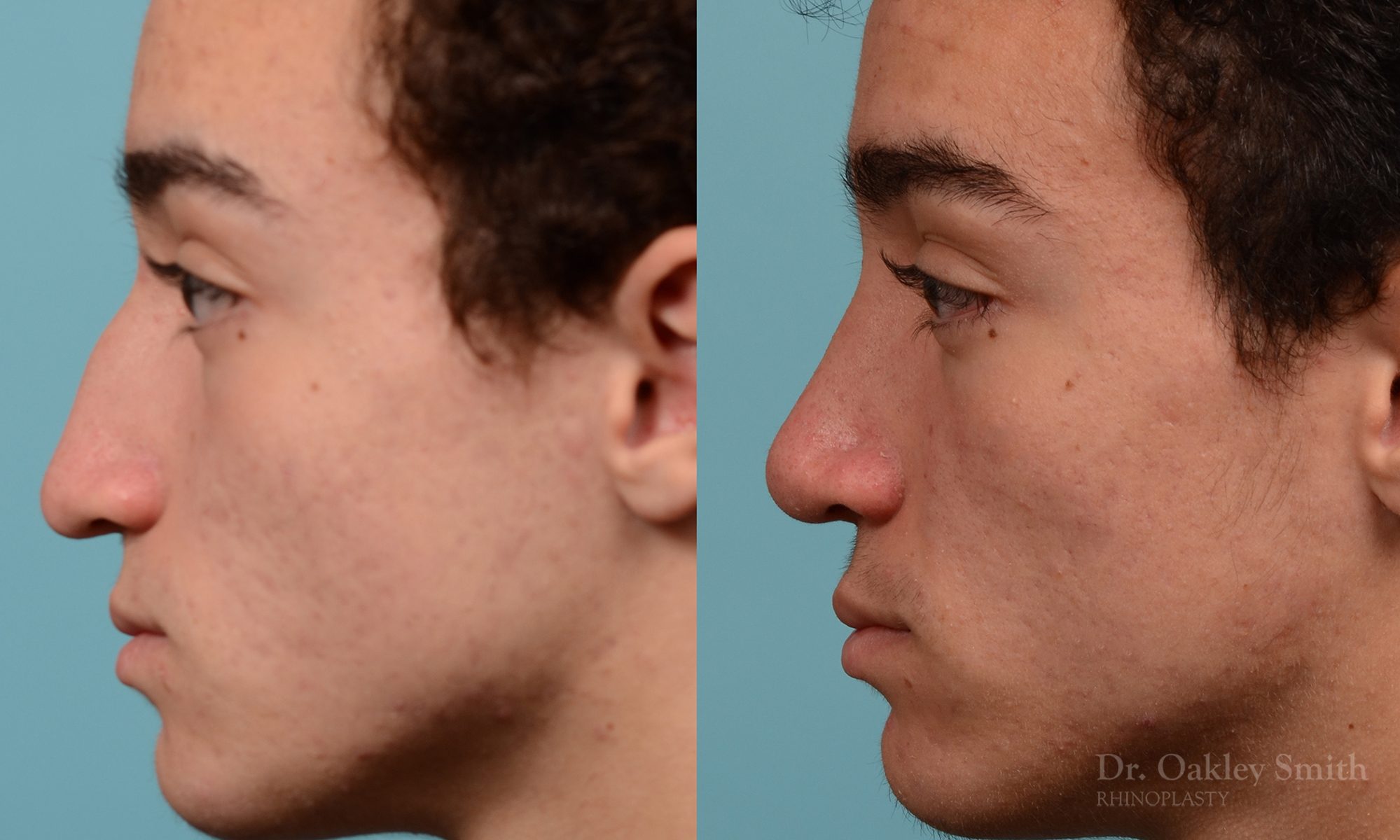 Broken nose rhinoplasty