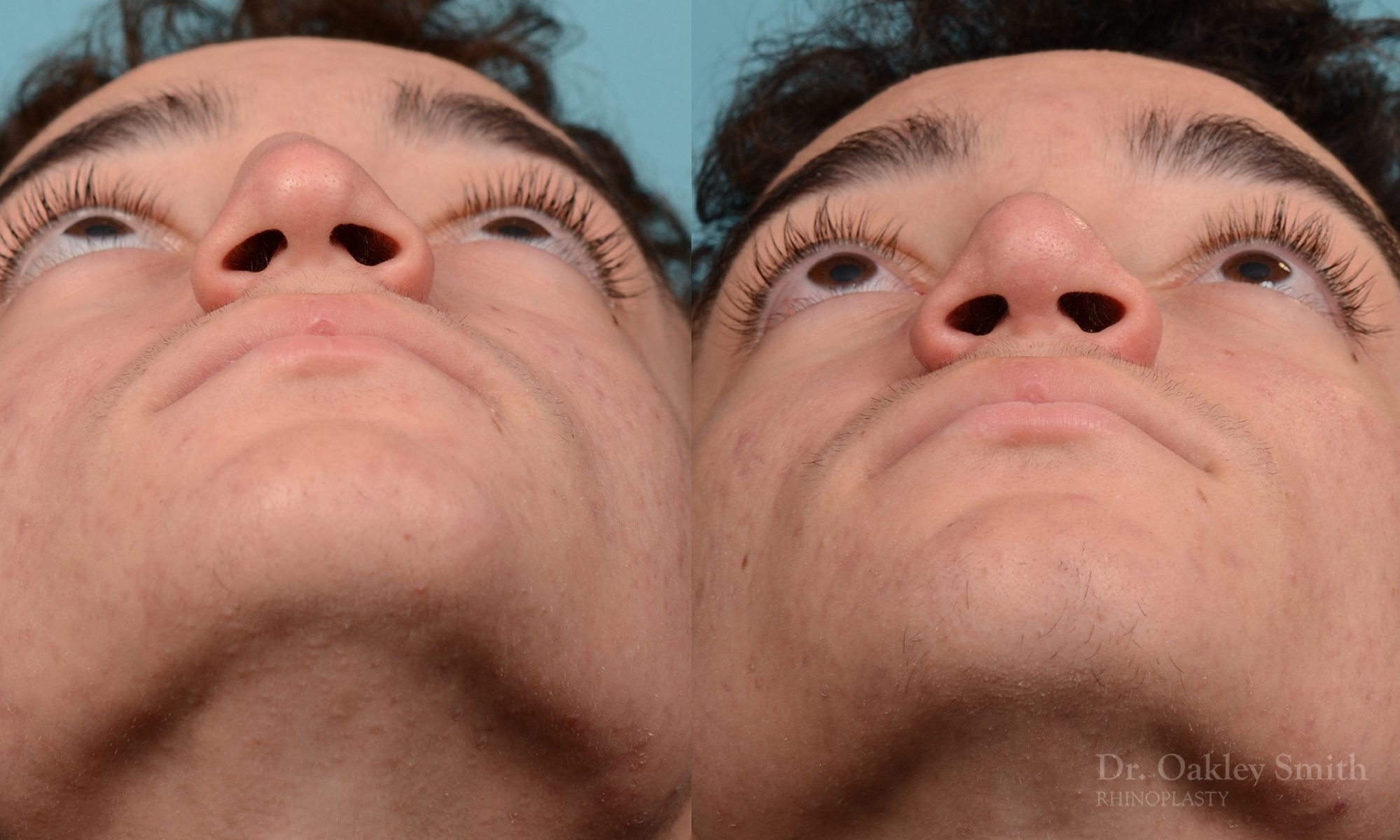 Broken nose rhinoplasty