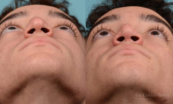 Broken nose rhinoplasty