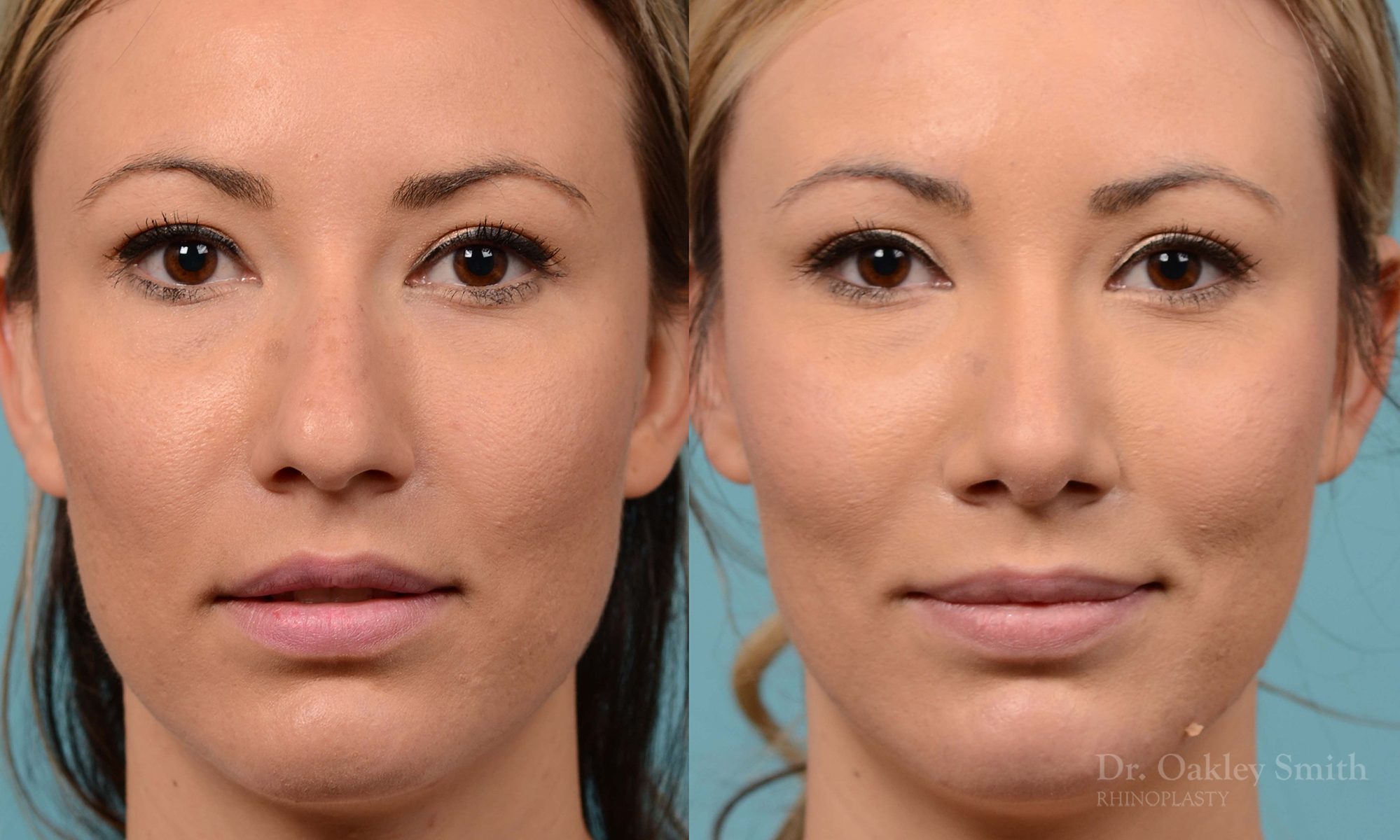 rhinoplasty bump removal