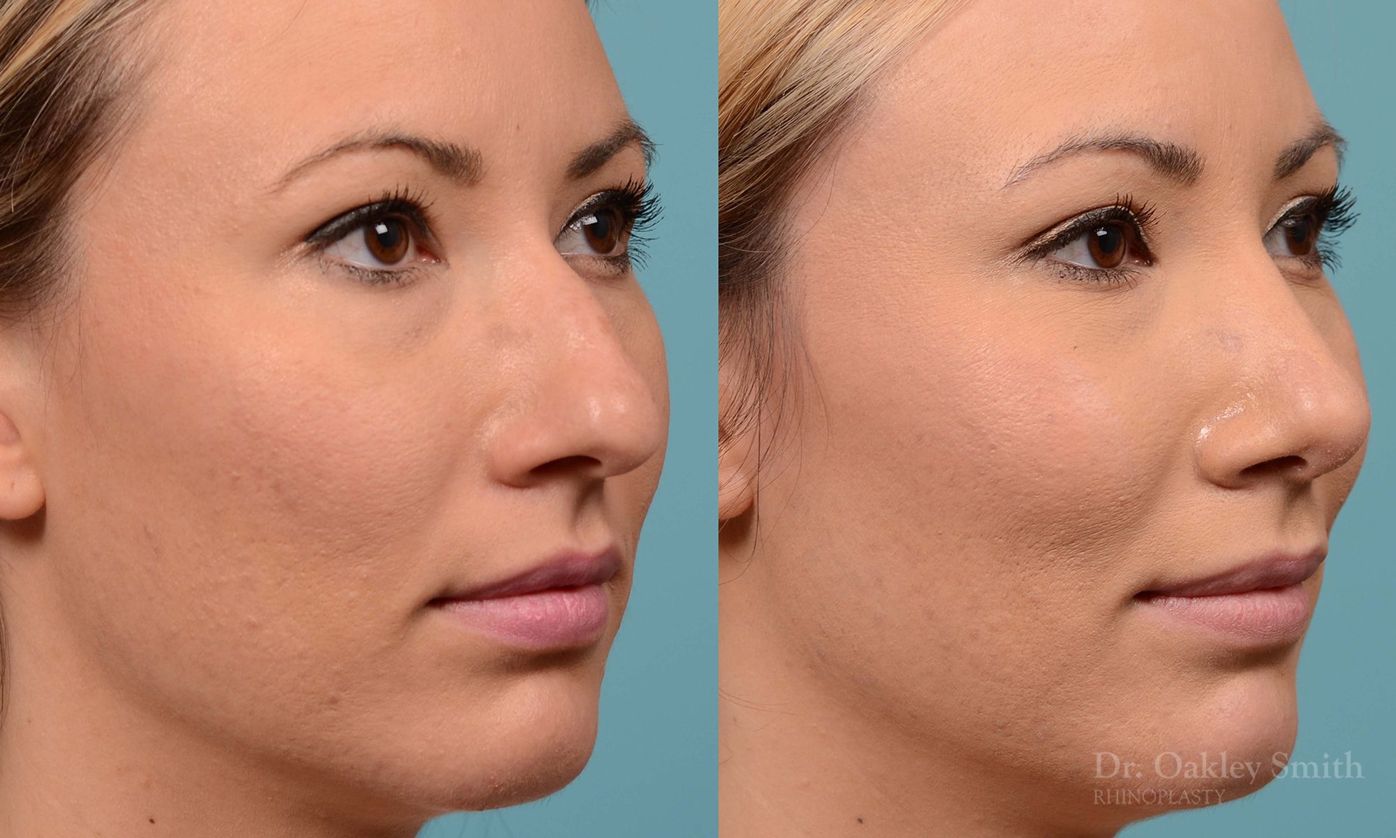 rhinoplasty bump removal