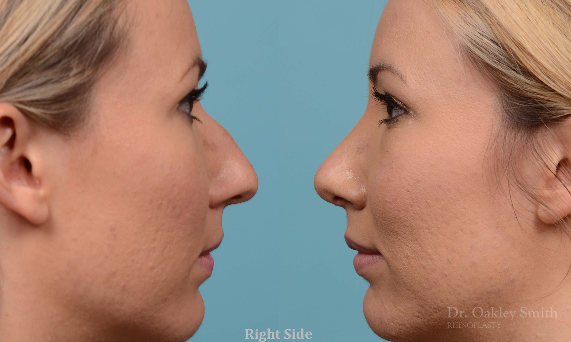 rhinoplasty bump removal