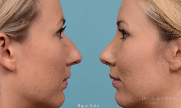 rhinoplasty bump removal