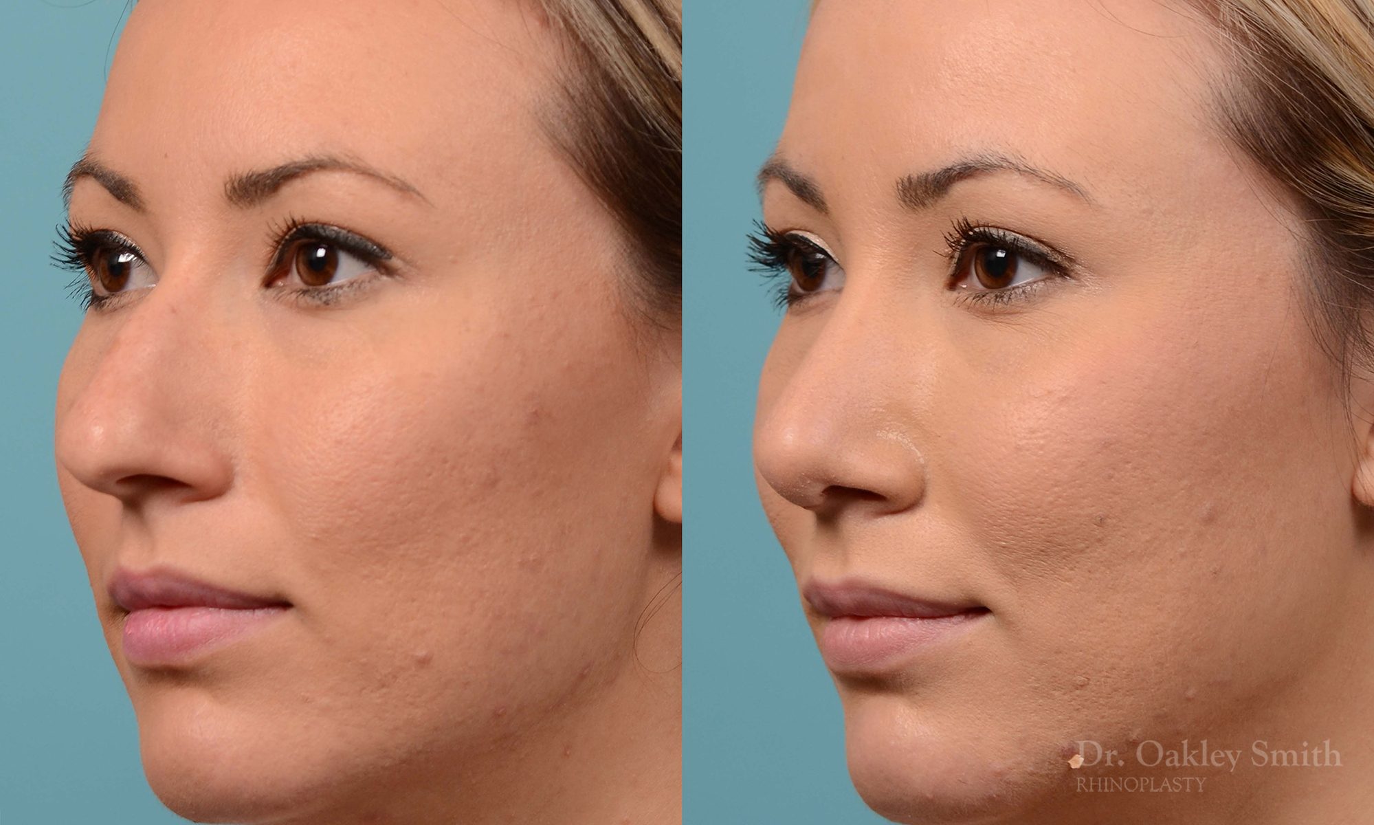 rhinoplasty bump removal
