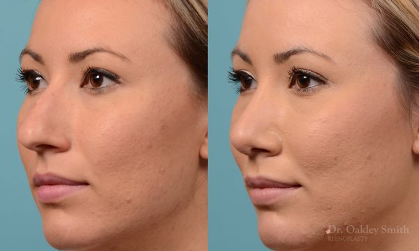 rhinoplasty bump removal