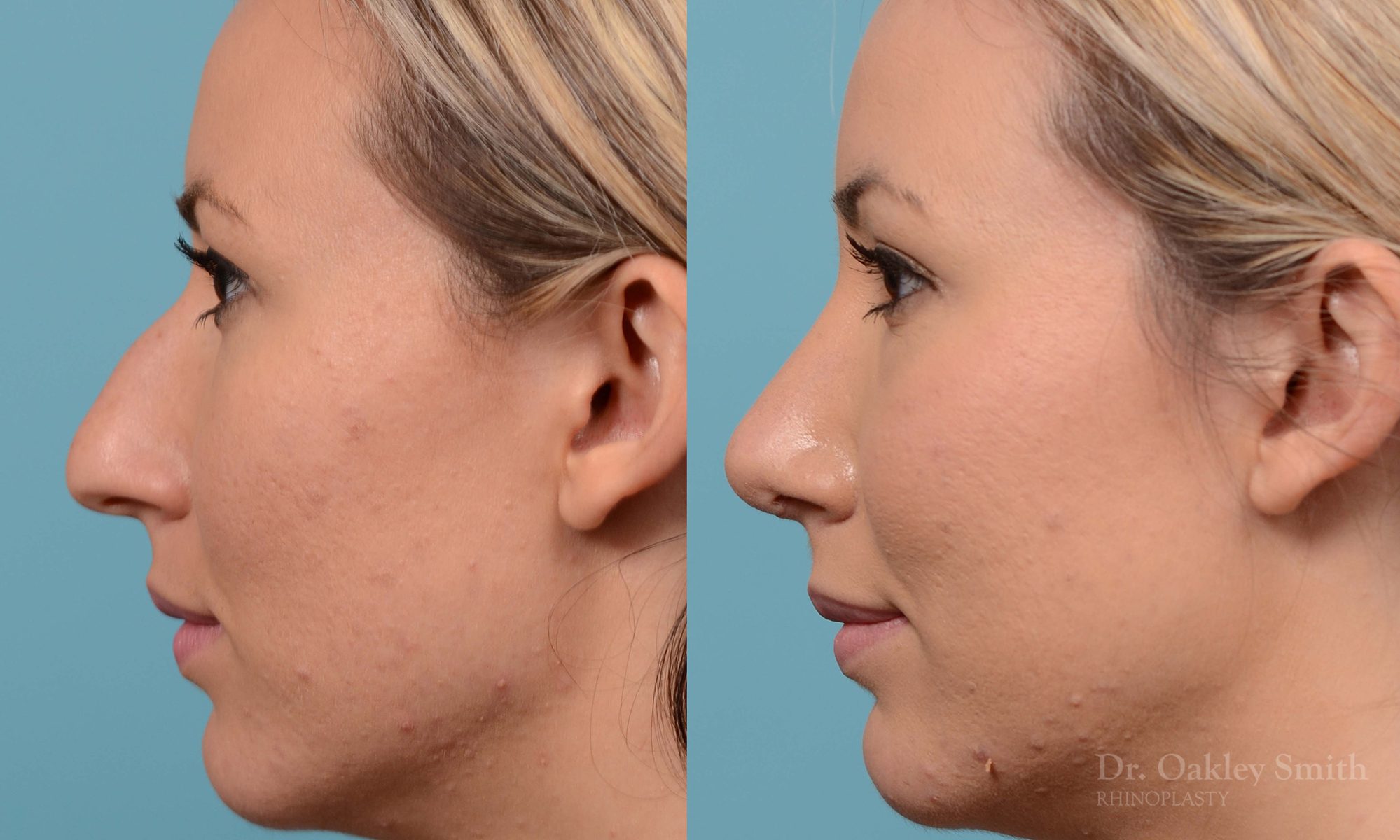 rhinoplasty bump removal