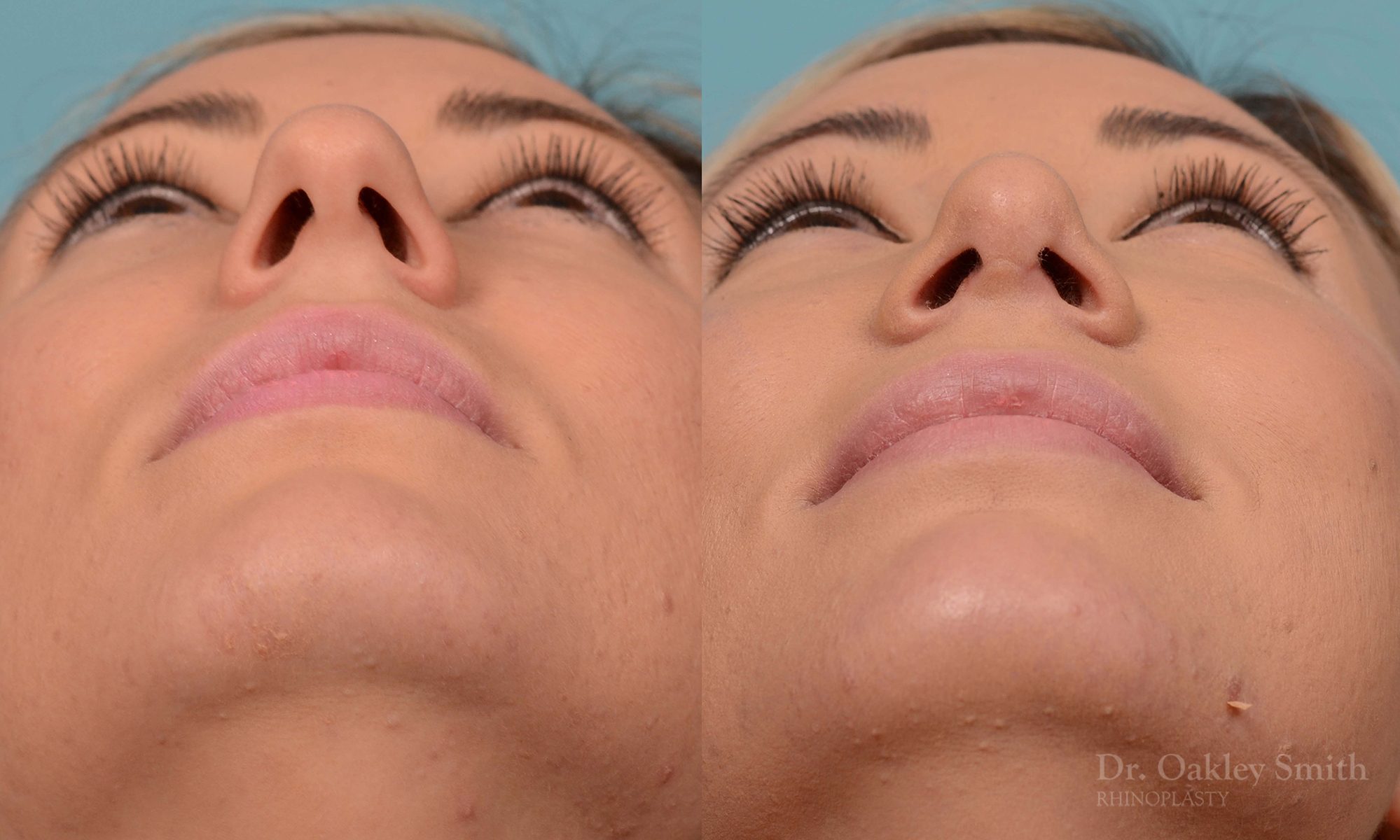 rhinoplasty bump removal
