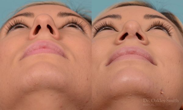 rhinoplasty bump removal