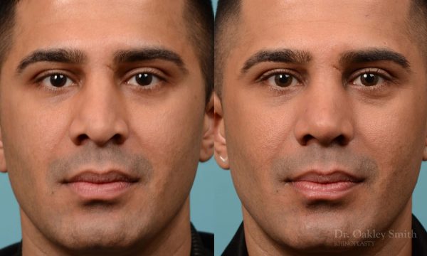 Nose reduction and bse of nose narrowing