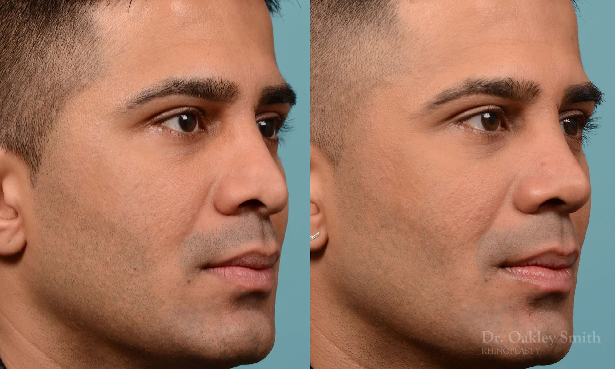 Nose reduction surgery and base of nose narrowing