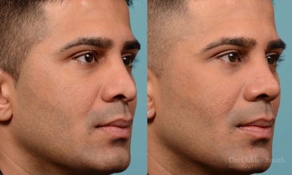 Nose reduction surgery and base of nose narrowing