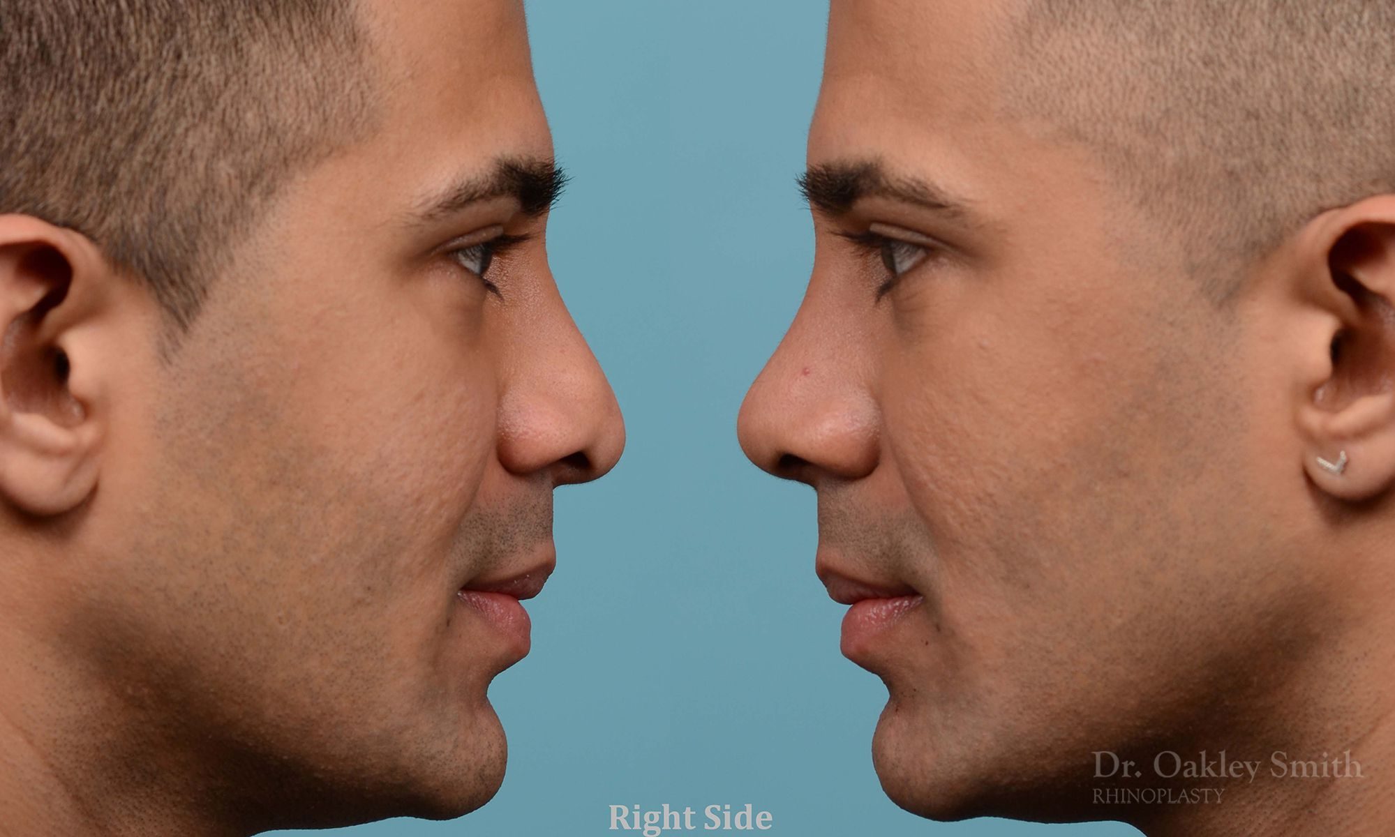 Nose reduction surgery and base of nose narrowing