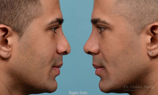 Nose reduction surgery and base of nose narrowing