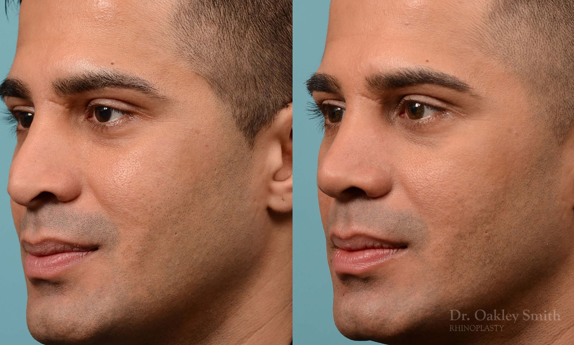Nose reduction surgery and base of nose narrowing