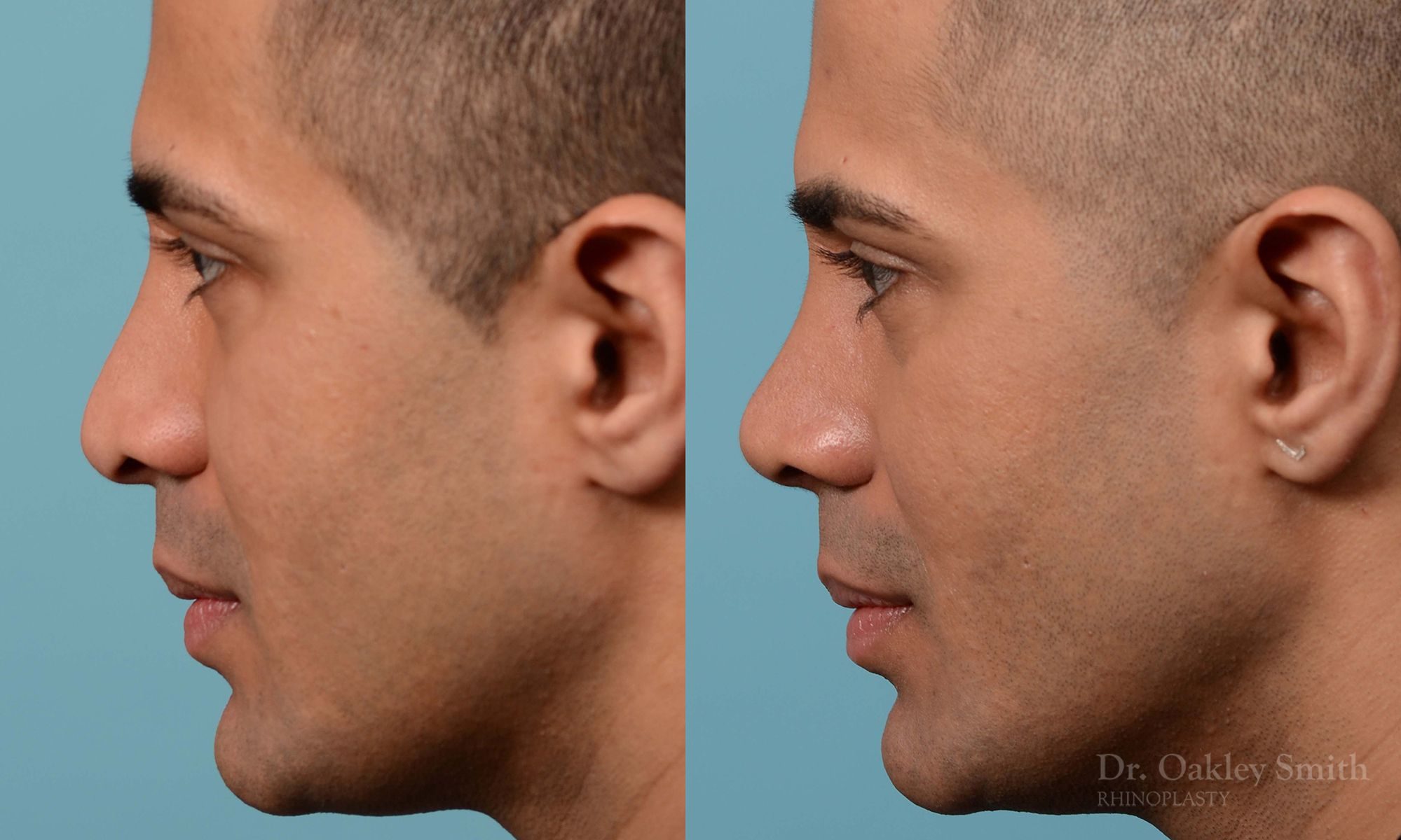 Nose reduction surgery and base of nose narrowing