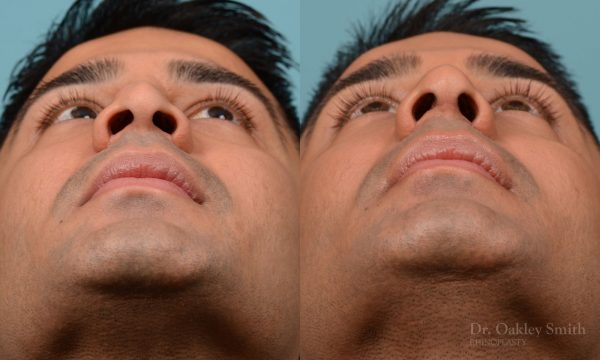 Nose reduction rhinoplasty and base of nose narrowing