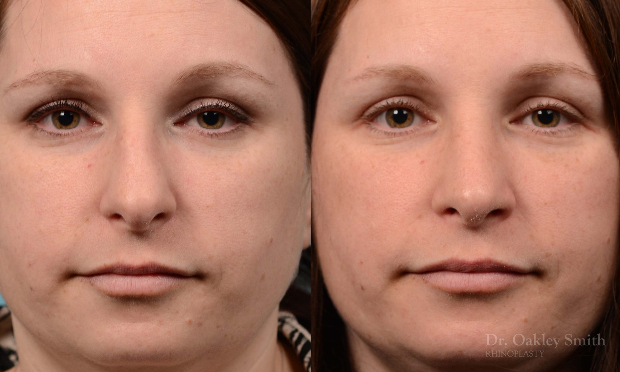 rhinoplasty nose surgery on female
