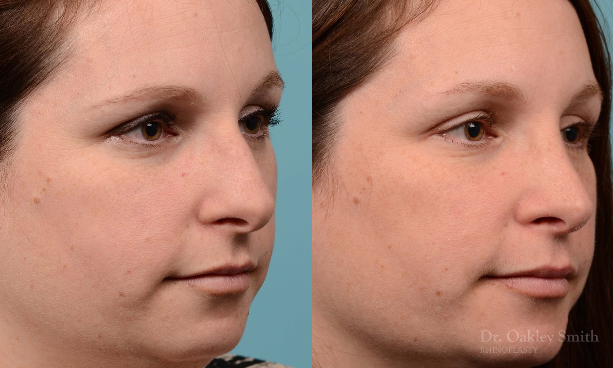rhinoplasty nose surgery on female