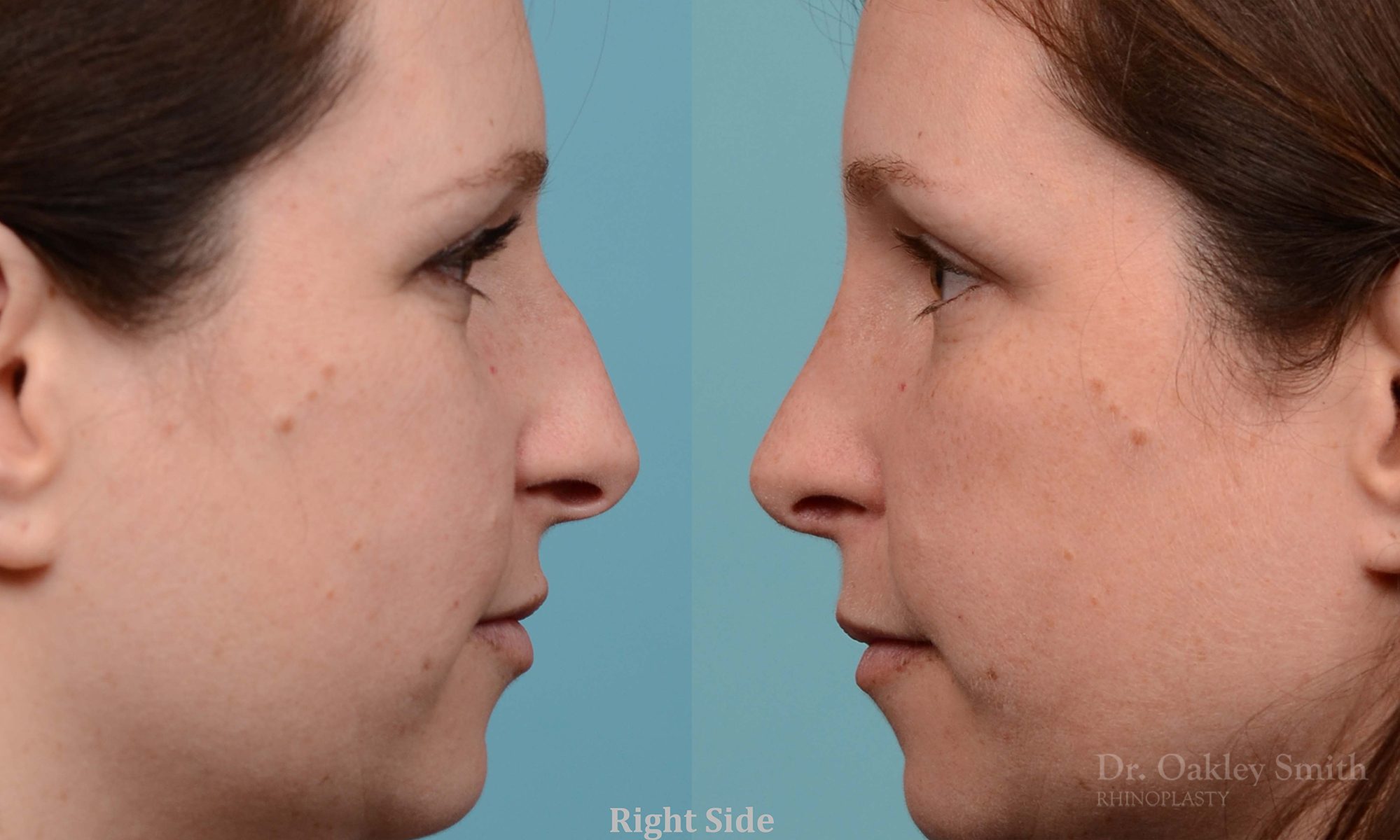 rhinoplasty nose surgery on female