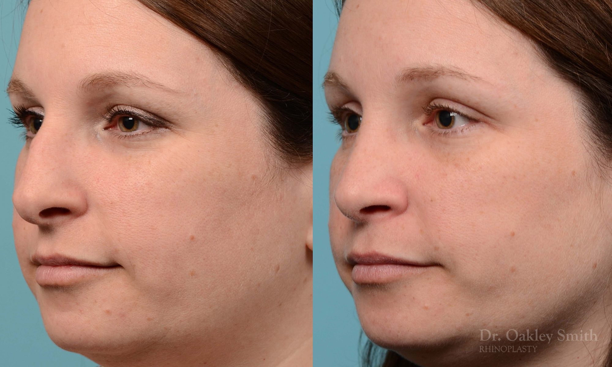 rhinoplasty nose surgery on female