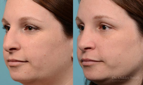 rhinoplasty nose surgery on female