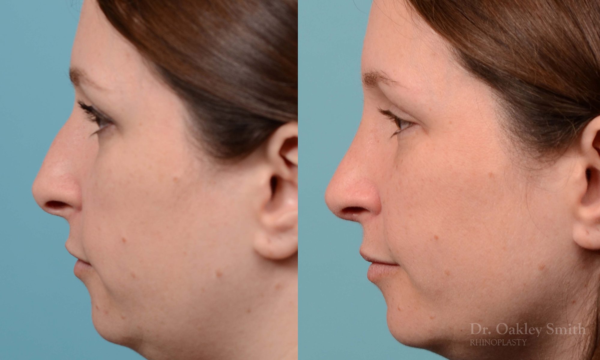 rhinoplasty nose surgery on female