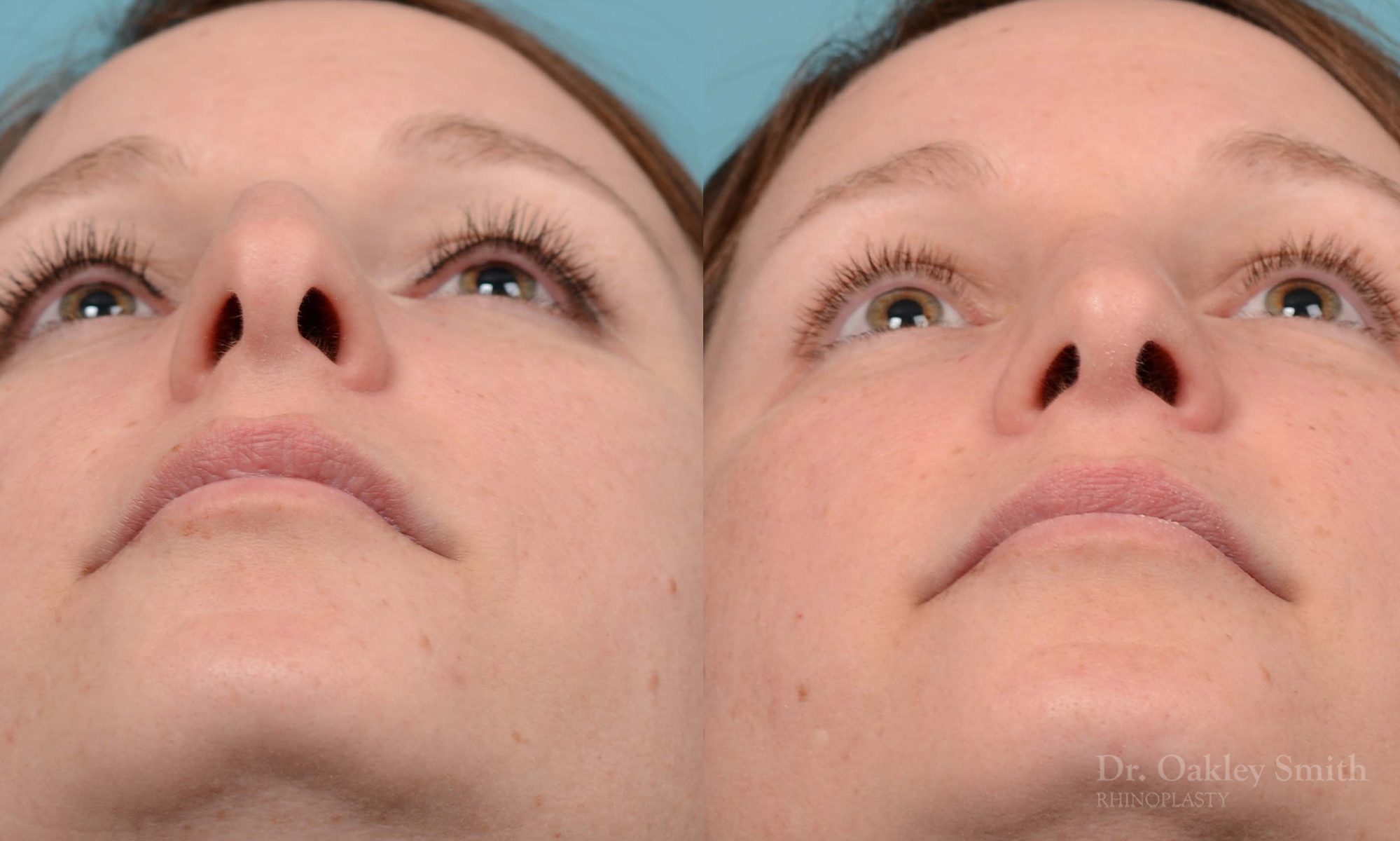 rhinoplasty nose surgery on female