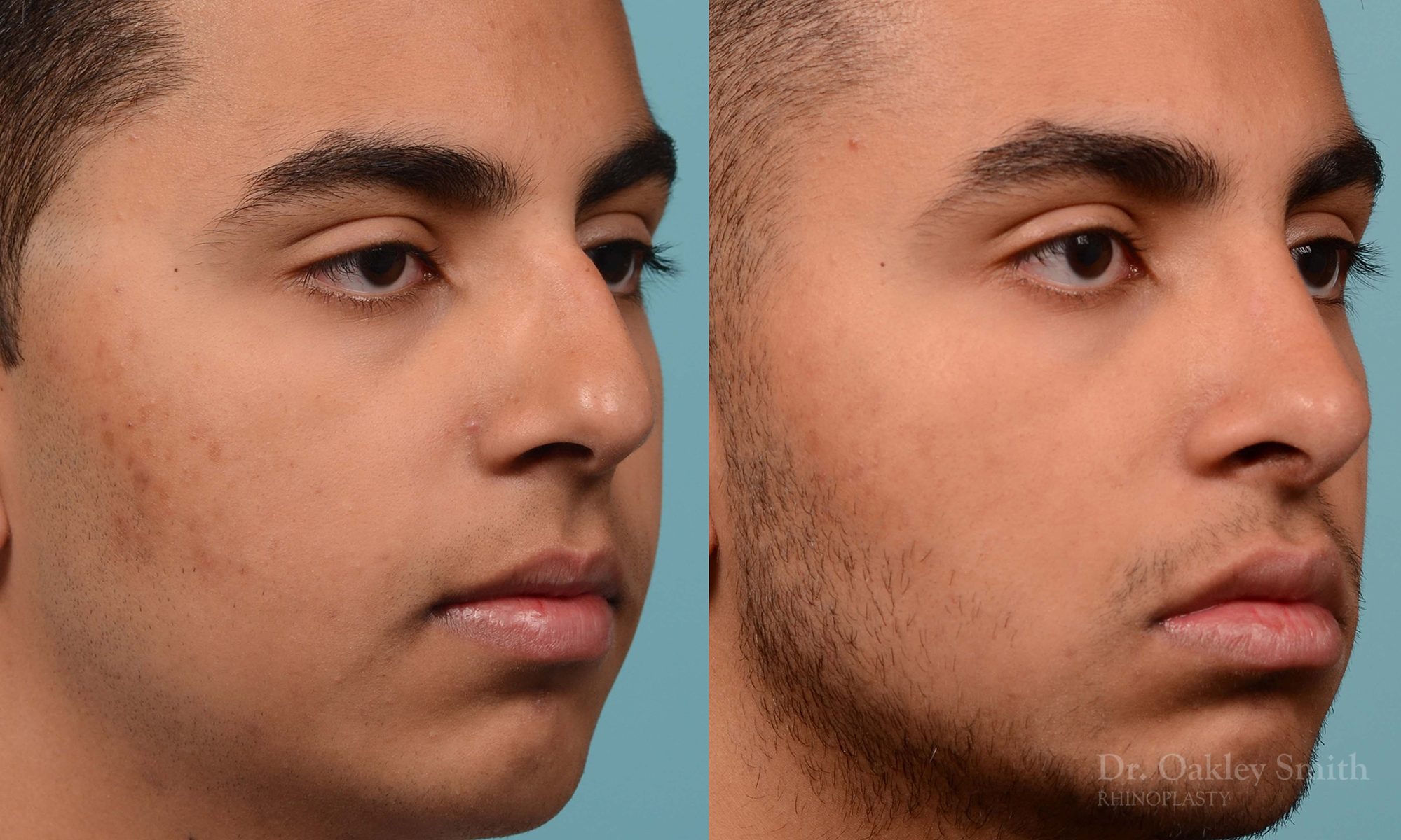 Hump reduction rhinoplasty on young male