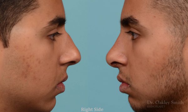 Hump reduction rhinoplasty on young male