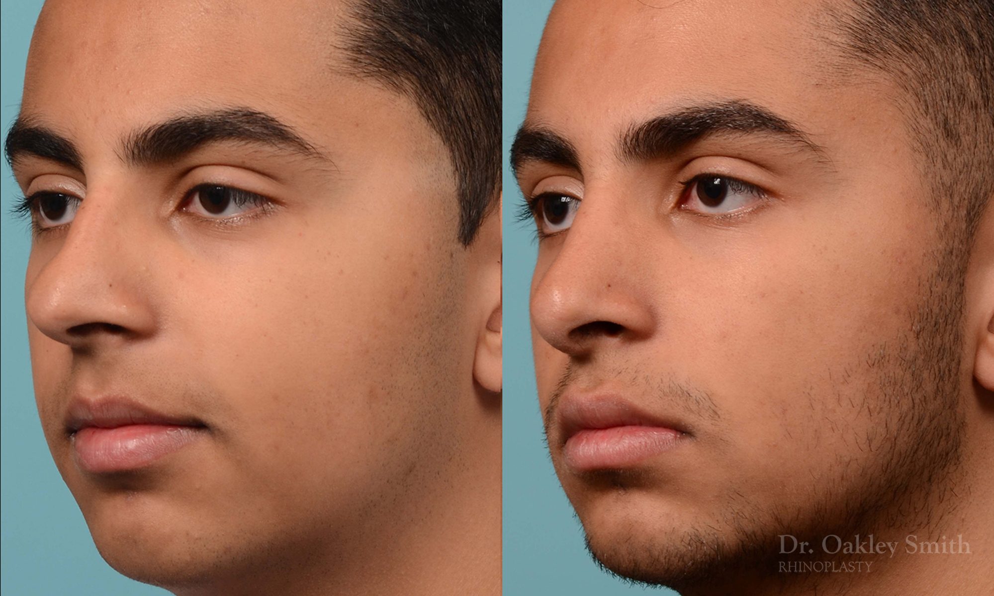Hump reduction rhinoplasty on young male
