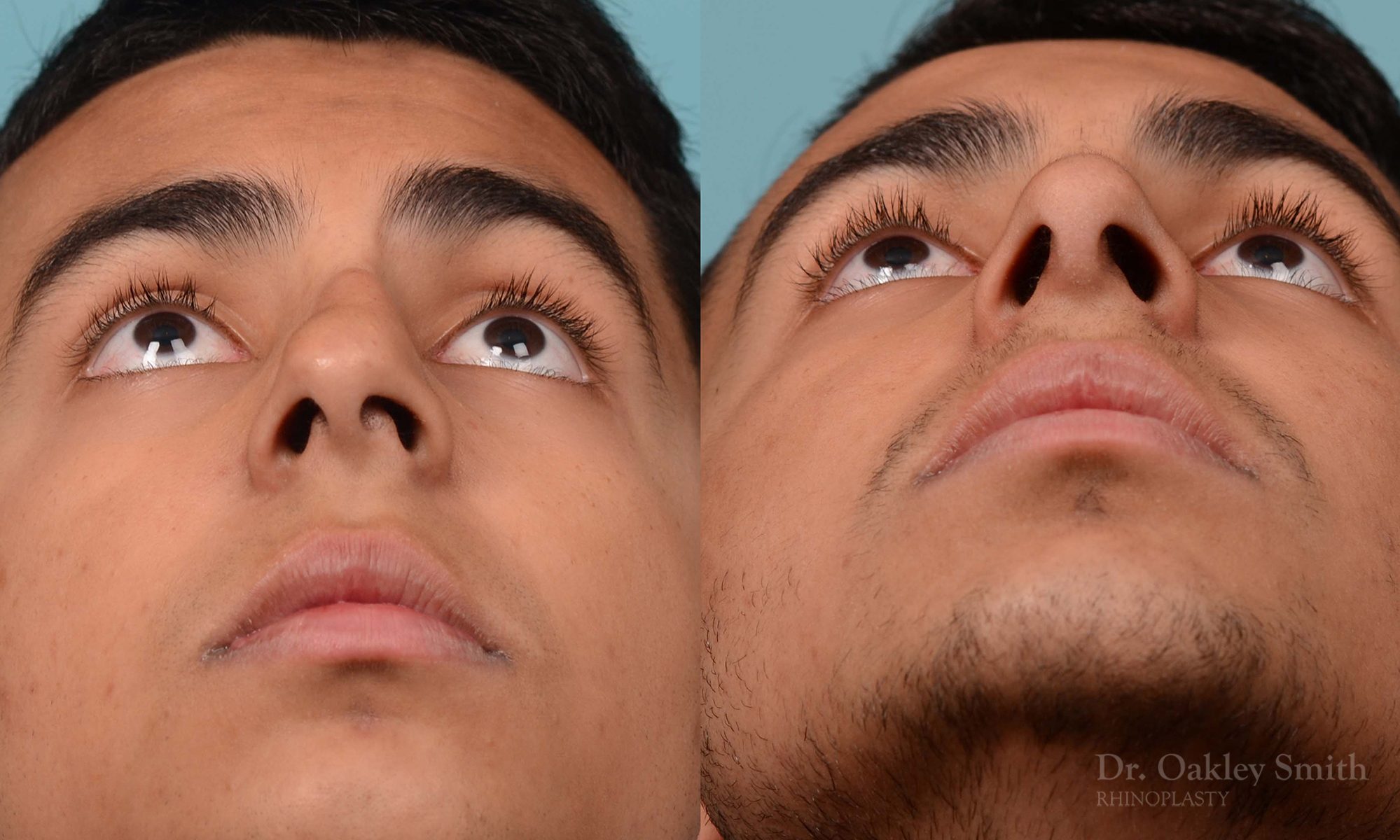 Hump reduction rhinoplasty on young male