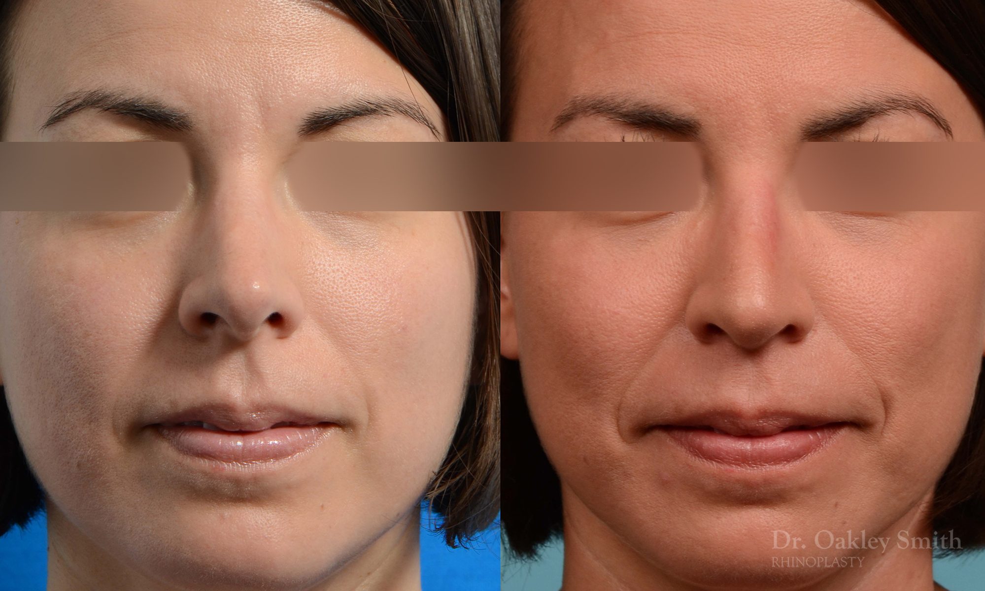 rhinoplasty tip reduction