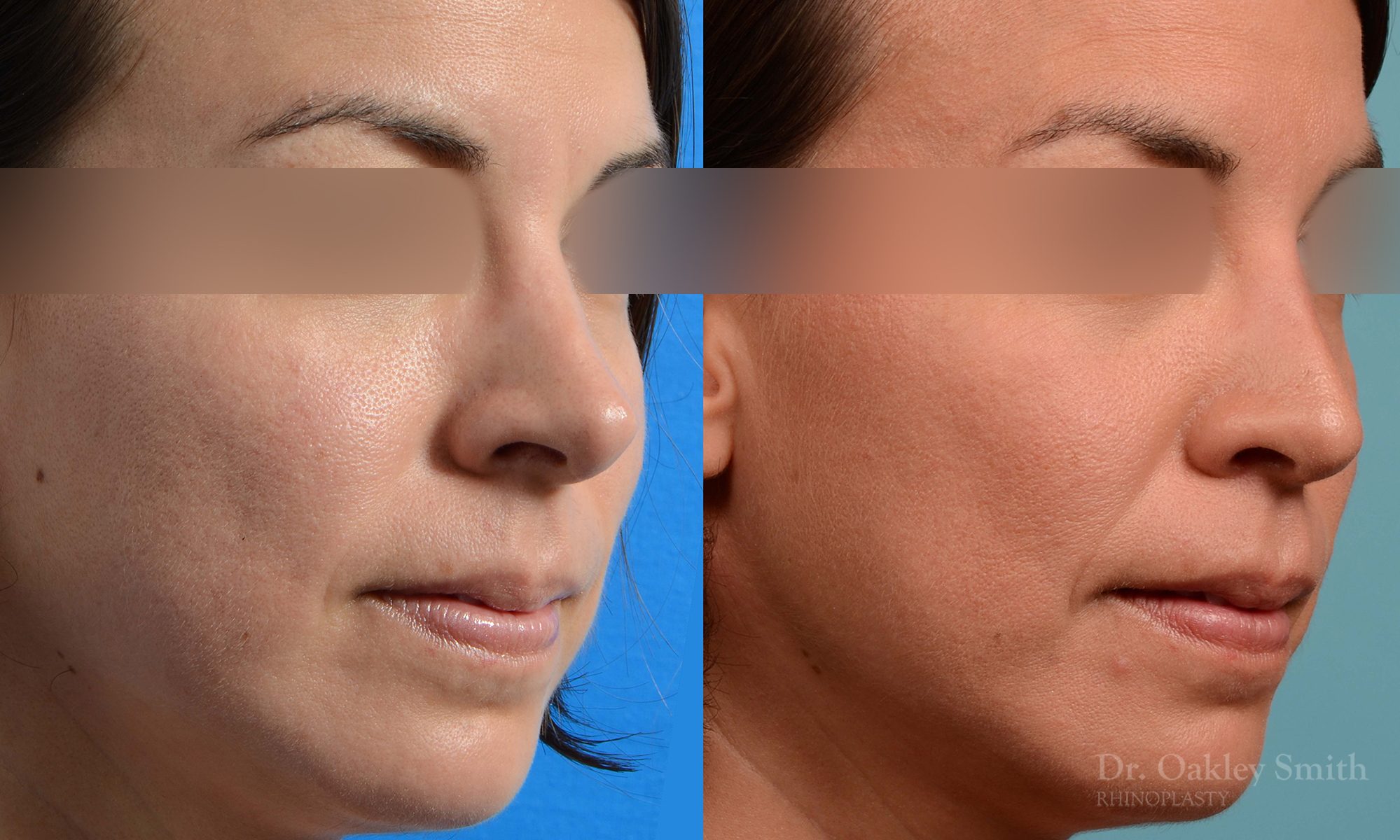 rhinoplasty tip reduction