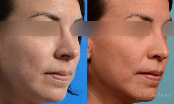rhinoplasty tip reduction