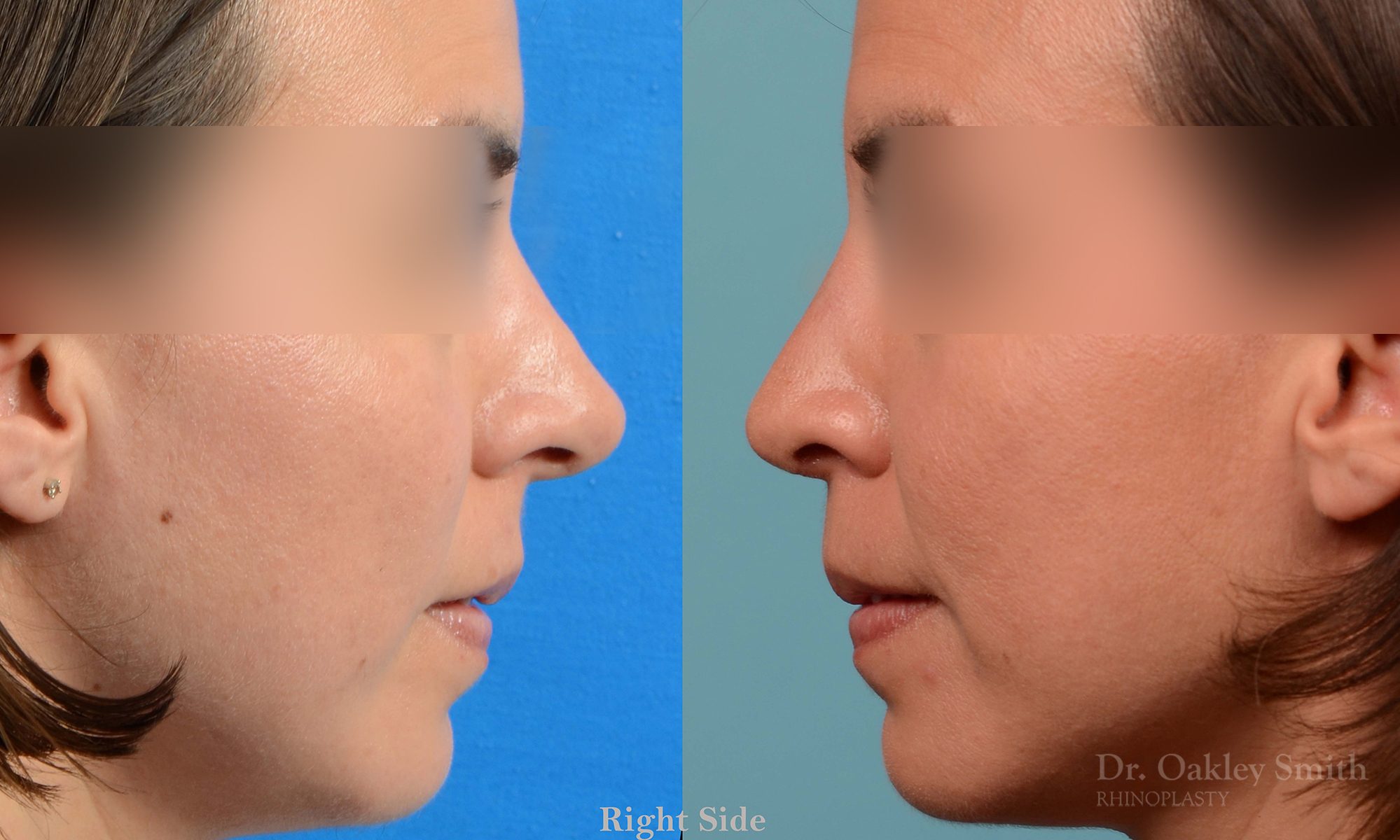 Rhinoplasty tip reduction