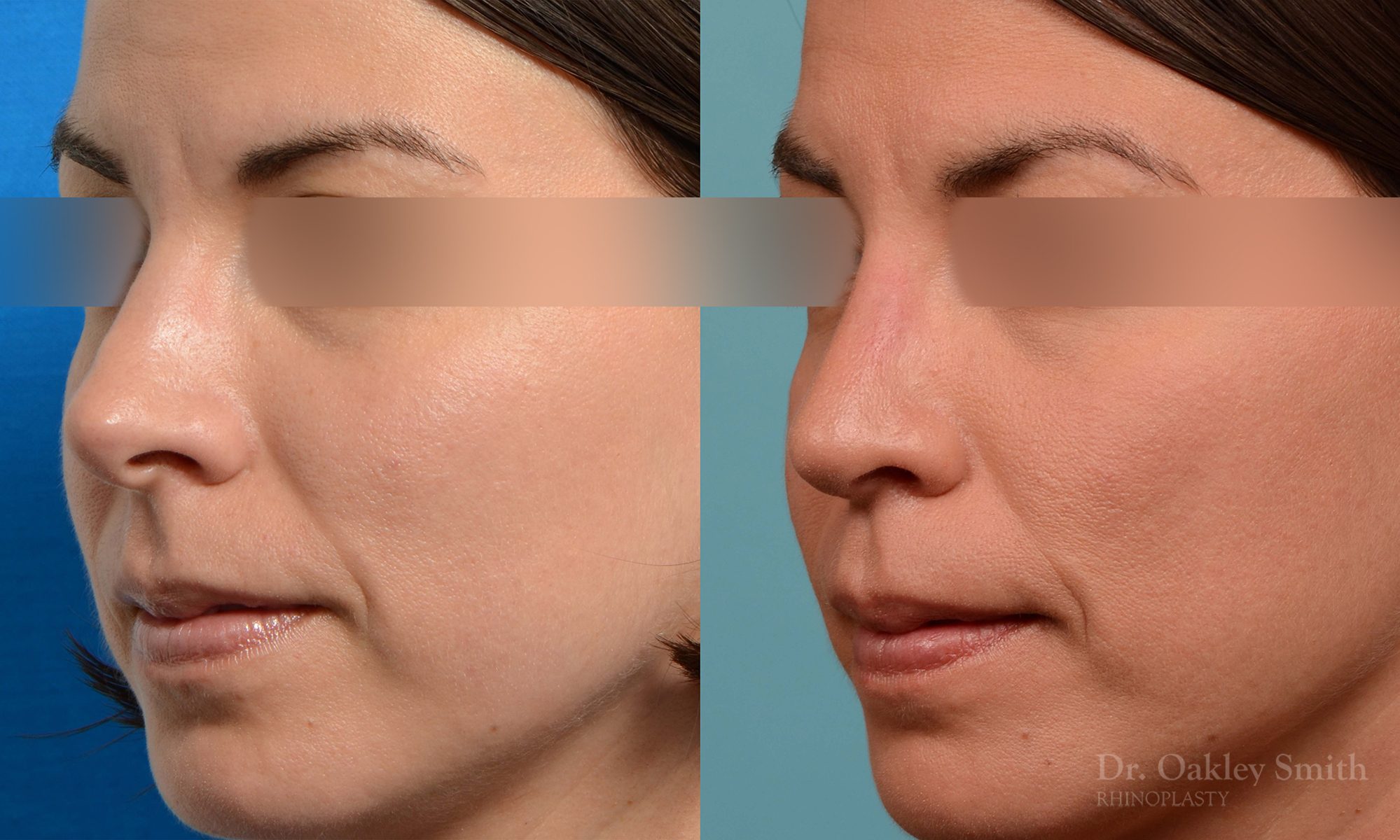 rhinoplasty tip reduction